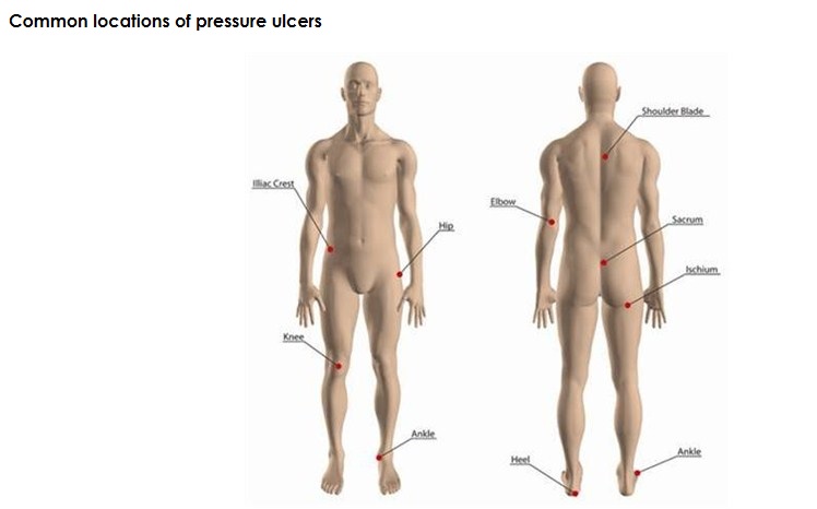 Pressure ulcer common locations
