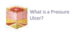 What is pressure ulcer What is pressure ulcer